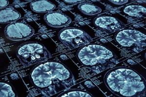 Pesquisa quer avaliar conhecimento de mdicos generalistas sobre neurologia